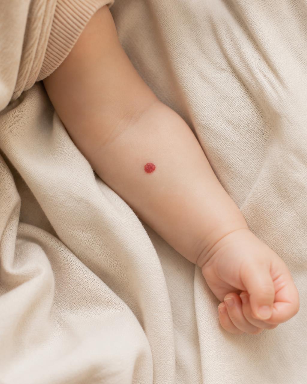 Hemangiomas
