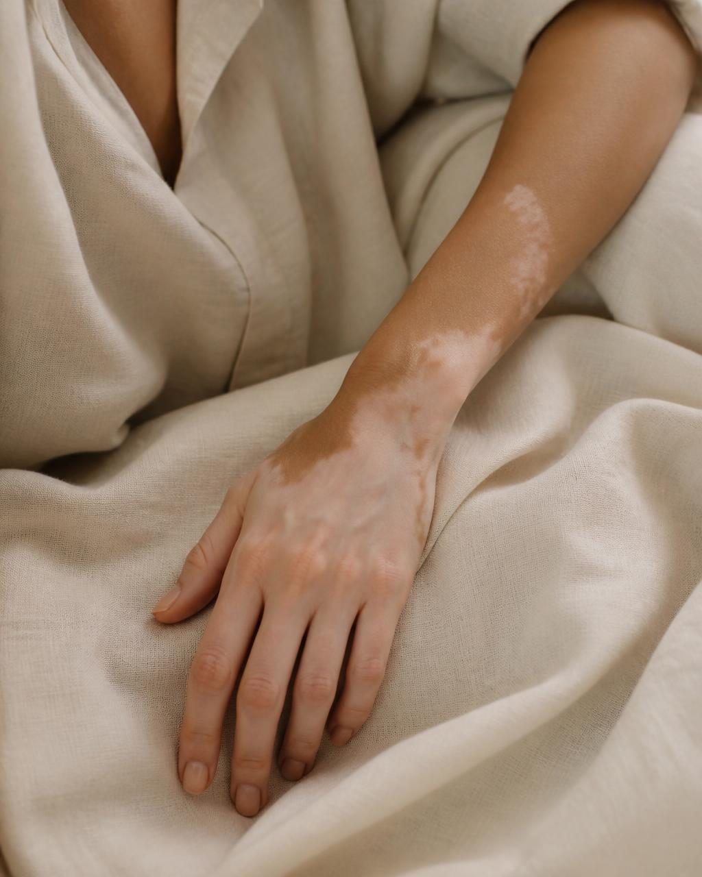 Vitiligo